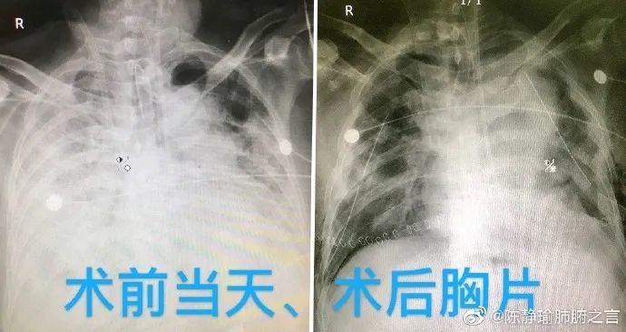 关于新肺最新情况的深度探讨与解析