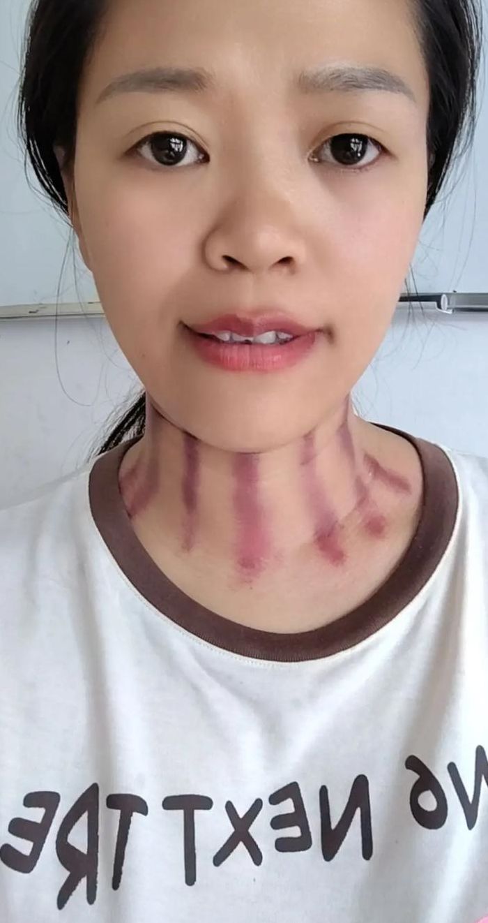 揪颈胸痧在当代的复兴，古老自然疗法的新生命