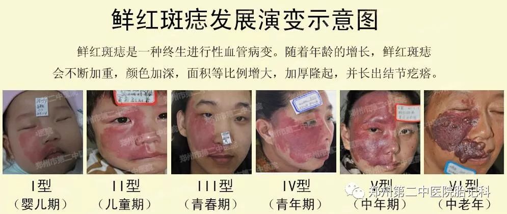 最新胎记治疗方法的研究进展探索